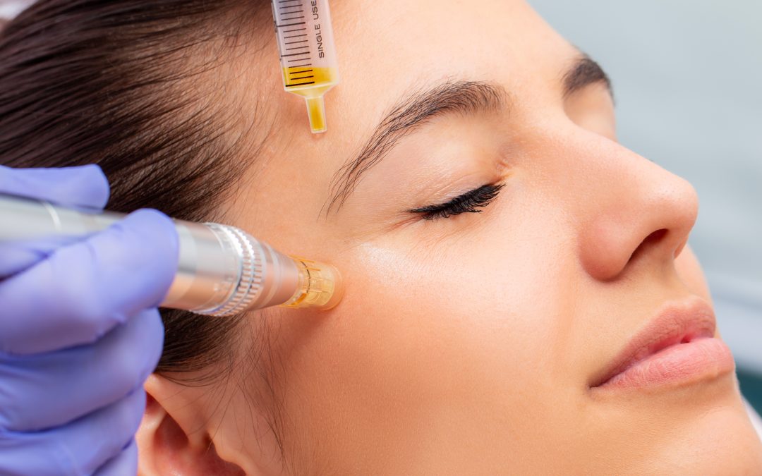 Needling